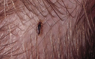 headlouse_closeup